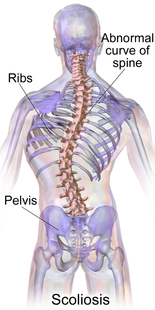 Pilates for scoliosis